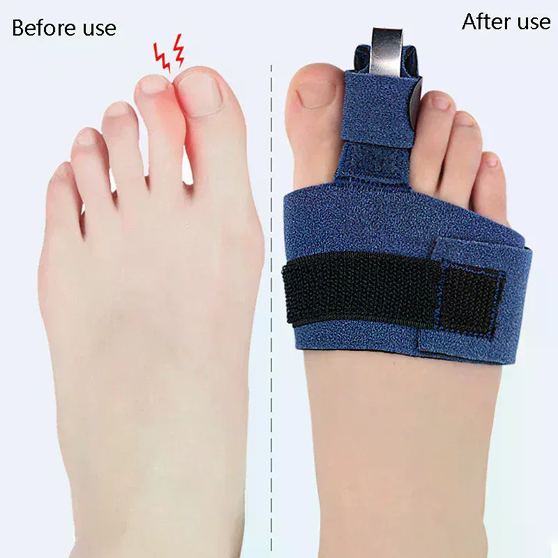 1 個の足指矯正器足指骨折固定具矯正器具足の骨親指アジャスタ - Ankle Brace Sock のレビューと価格